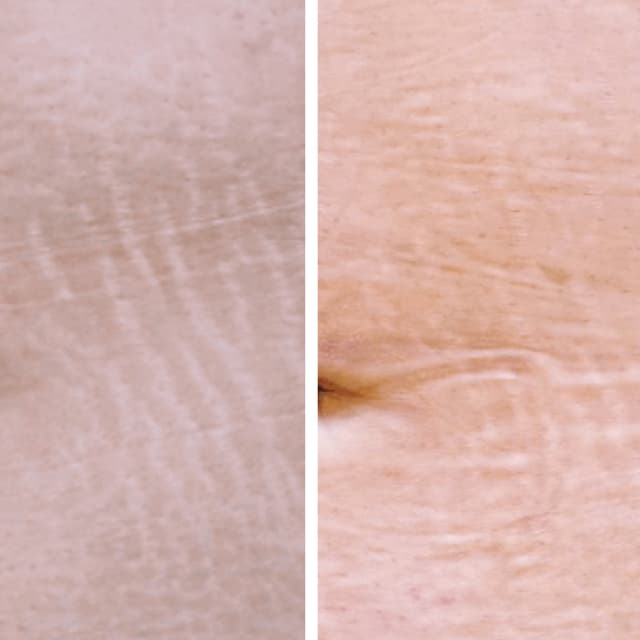 3 Sessions of ISR- Upper or Lowers at Flourish Skin Artistry in Redding, CA